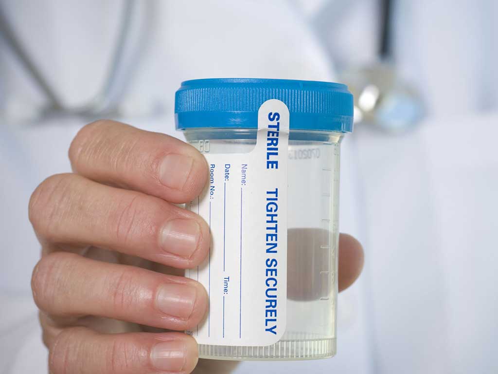 A professional handling an empty container for urine specimen collection