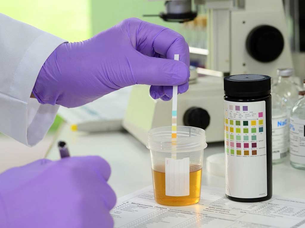A gloved hand dipping a test strip in a urine sample