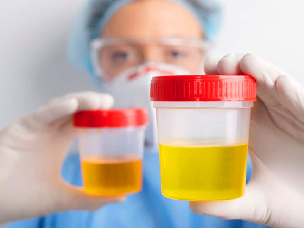 A lab technician wearing a protecting equipment holding two containers of urine sample