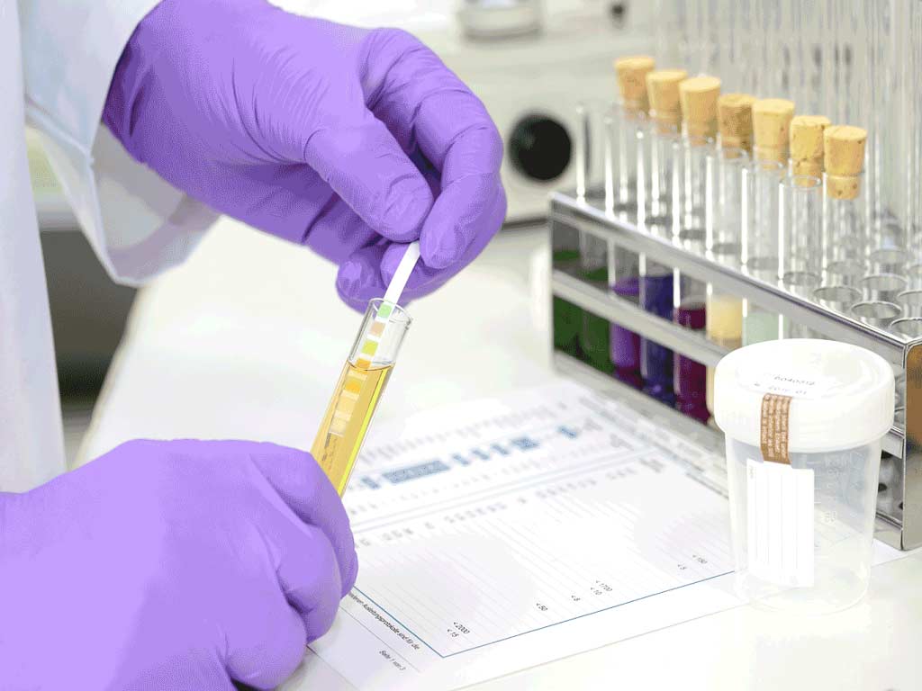 A lab professional dipping a test strip into a urine sample
