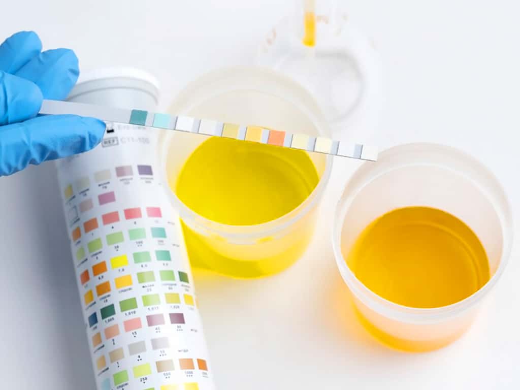 A lab professional comparing the colours of the urine samples to the colour chart