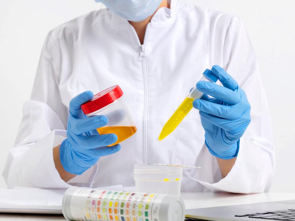 A lab technician holding a container and tube with urine samples inside