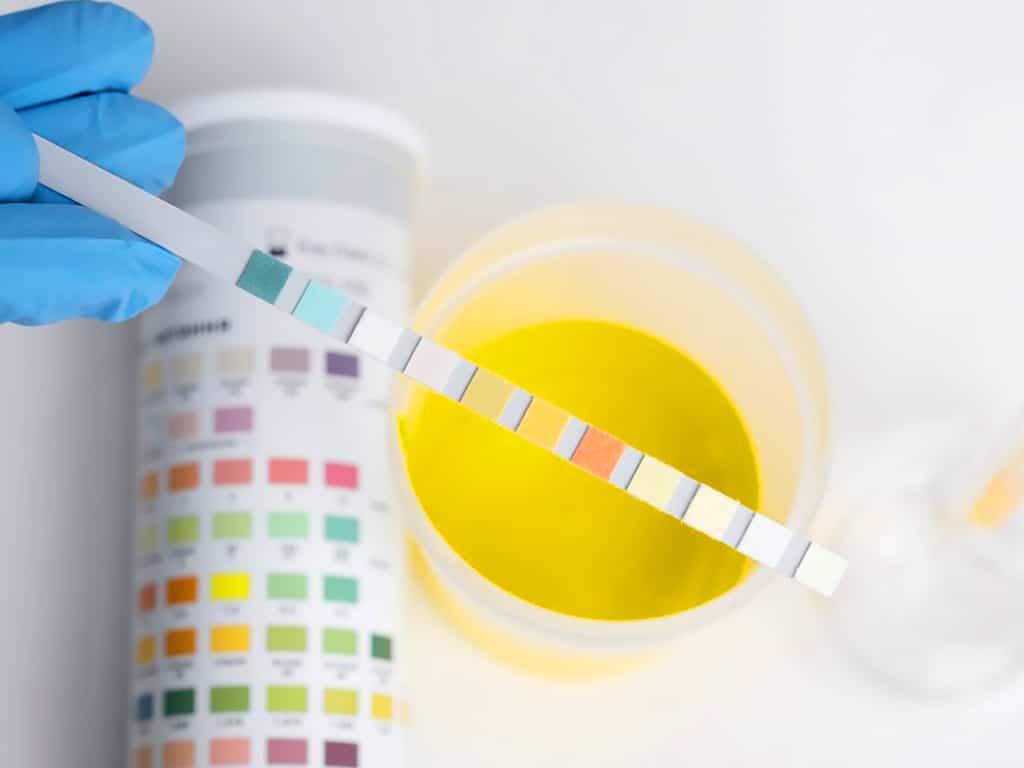 A professional analysing a urine sample with a colour chart